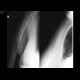 Pathological fracture of humerus: X-ray - Plain radiograph
